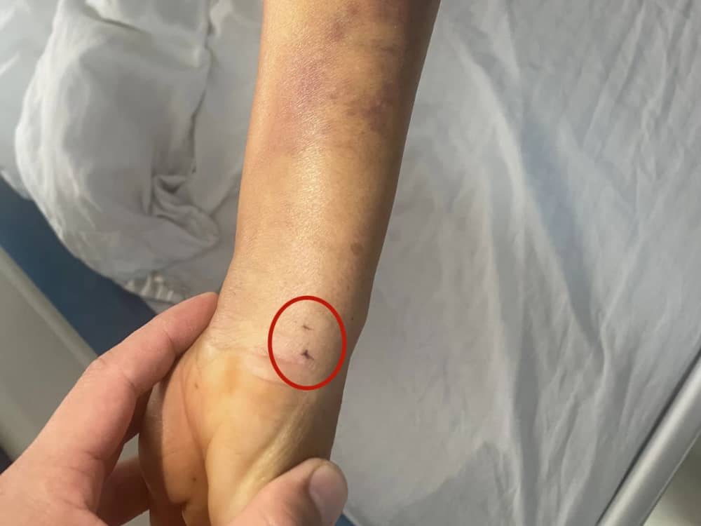 被蛇咬傷怎么辦？ 福德醫(yī)院教你毒蛇咬傷急救指南